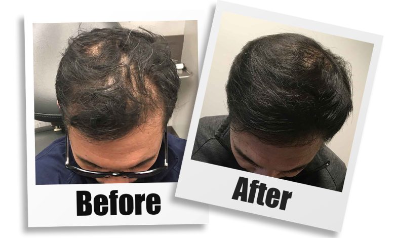 Acell hair loss- Non-Surgical Hair Restoration - ACell + PRP for Hair